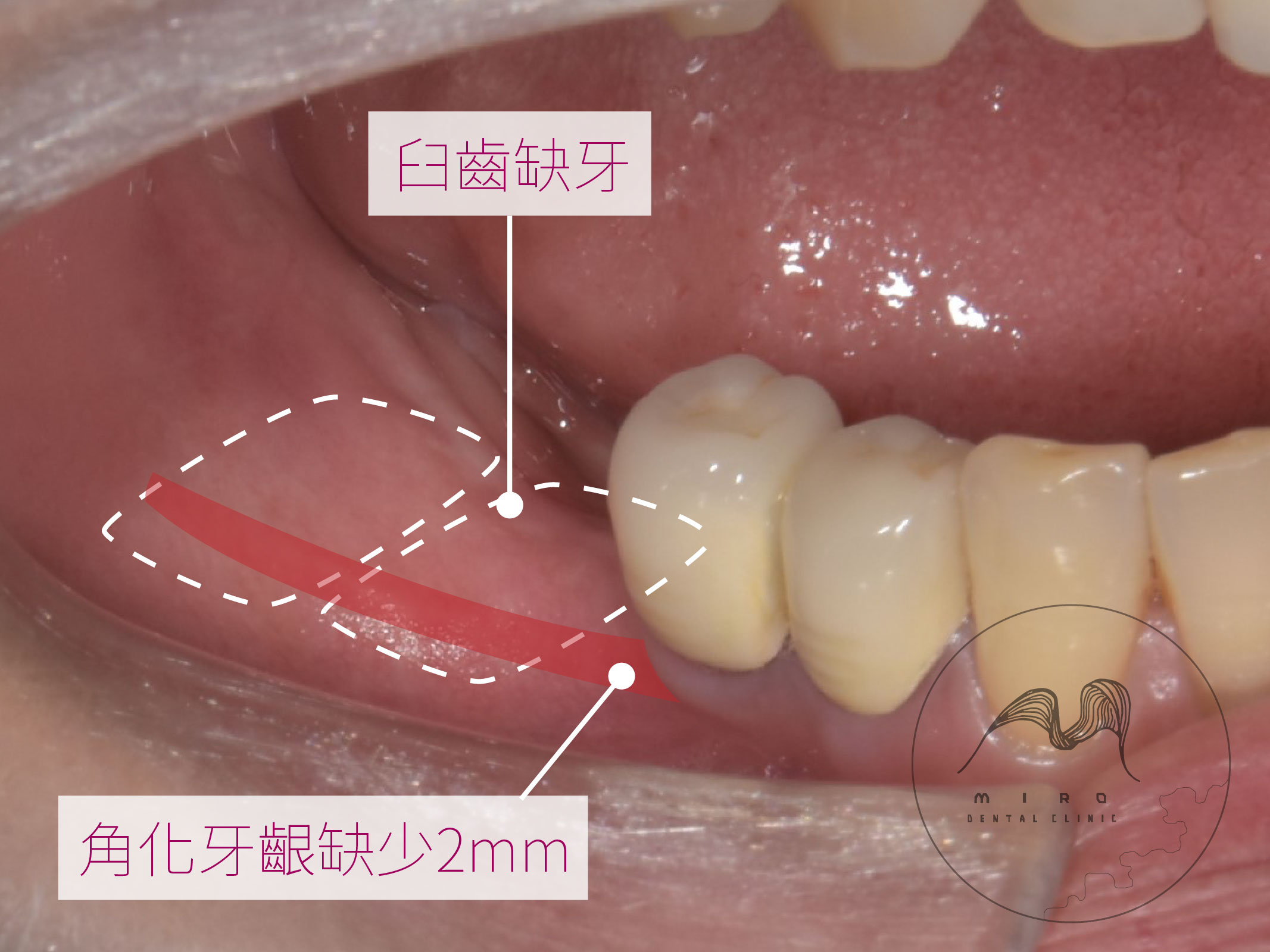 牙肉重建案例分享 - Dr. Implant 新竹光明牙醫診所