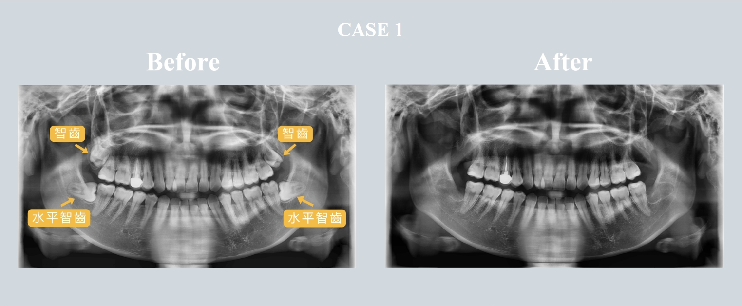 水平智齒拔除案例