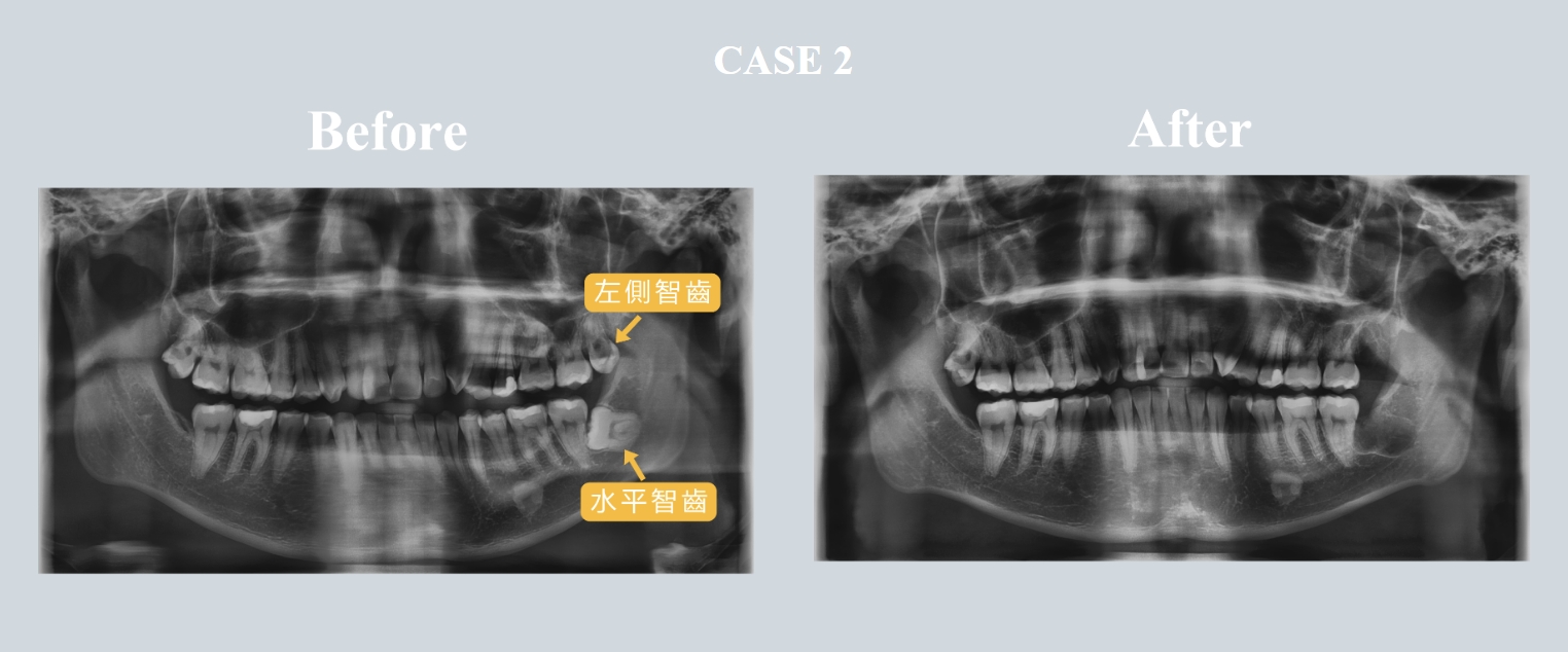 水平智齒拔除案例