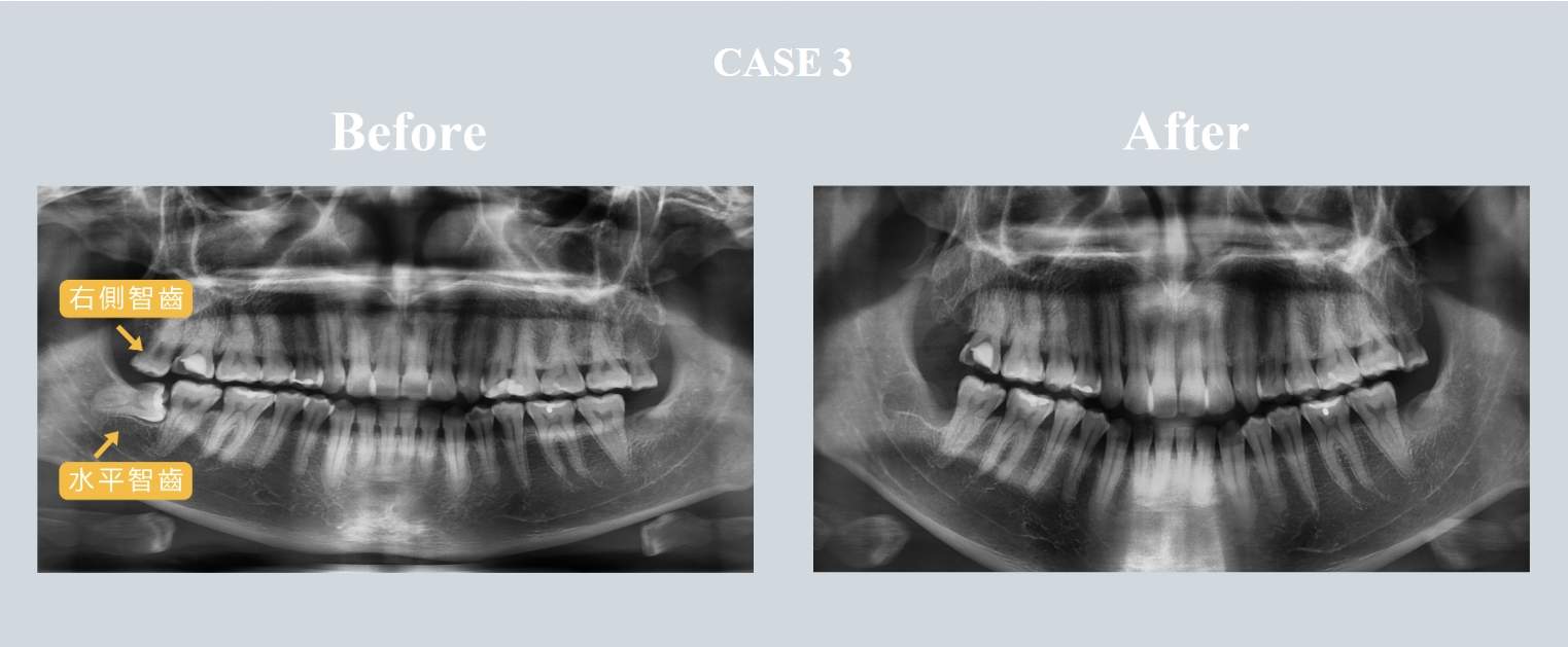 水平智齒拔除案例