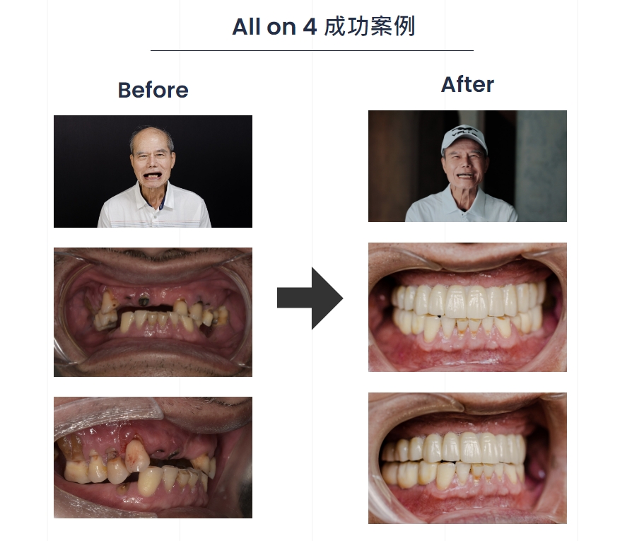 一日植牙成功案例