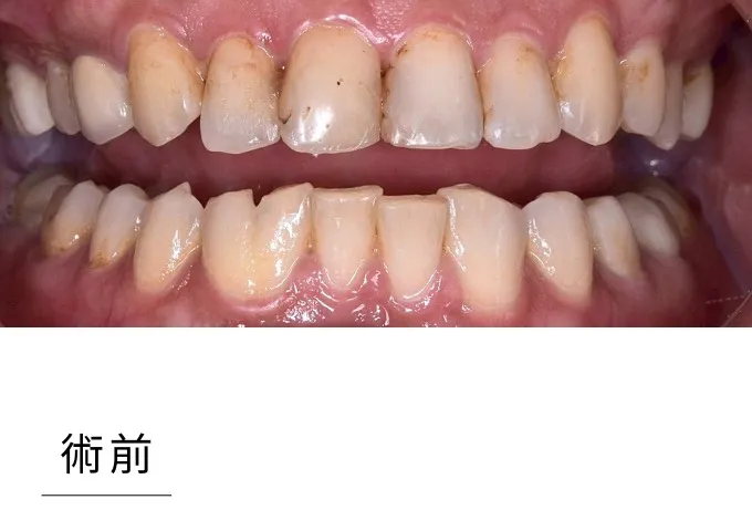 全瓷貼片-case 4 before