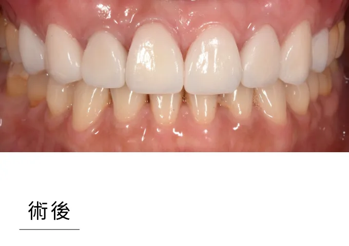 全瓷貼片-case1 after