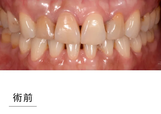 全瓷貼片-case1before