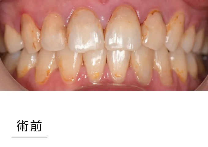 全瓷貼片-case2 beforepng