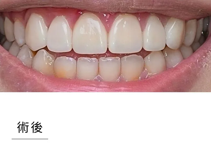 全瓷貼片-case3 after