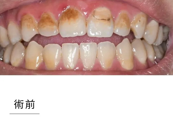 全瓷貼片-case3 before