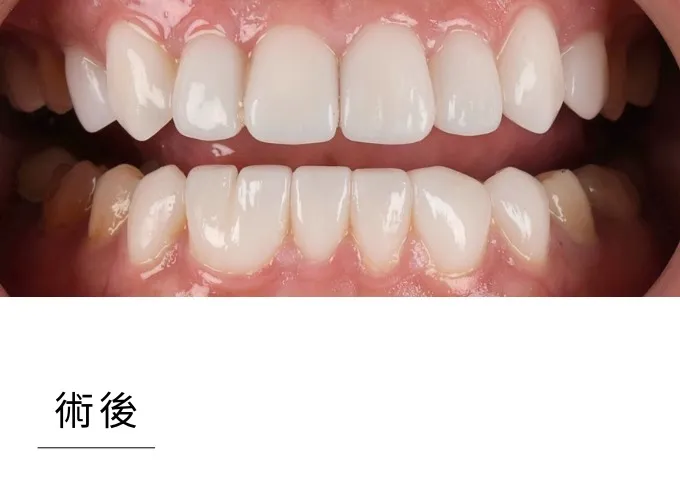 全瓷貼片-case4 after